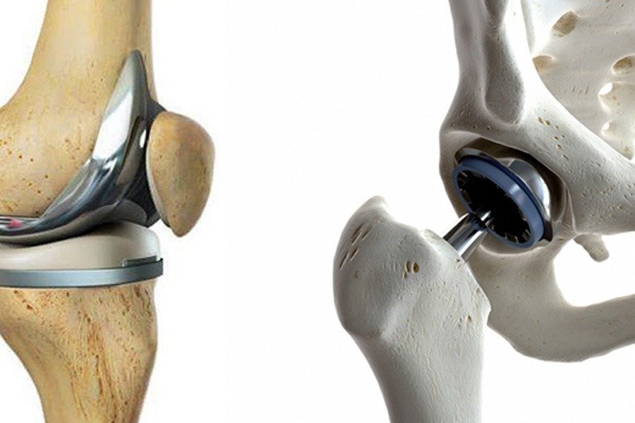 Hip & Knee Arthroplasty - Joint Replacement Surgery